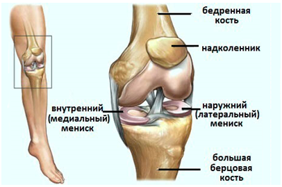 Разрыв латерального мениска коленного сустава