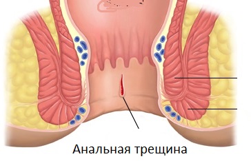 Анальная трещина - лечение острйо хронической трещины в СПб