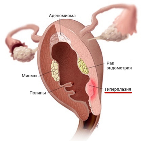 Причины железистой гиперплазии эндометрия