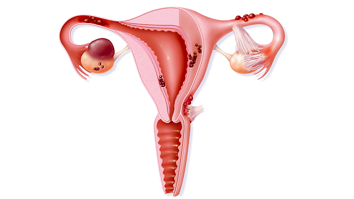 Народное лечение эндометриоза матки