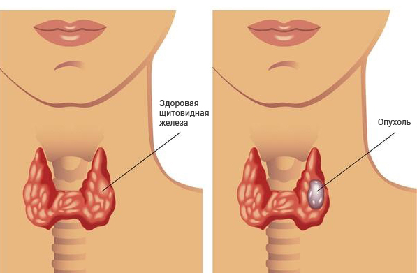 Симптомы заболеваний щитовидной железы, проявление признаков патологии щитовидной железы