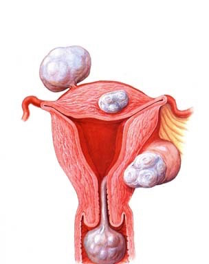 Гормональное лечение эндометриоза у женщин