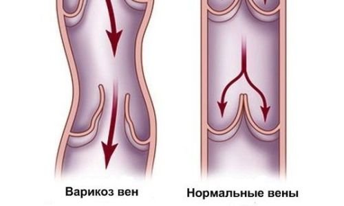 Лечение варикозного расширения вен на ногах