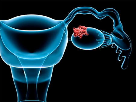 Рак яичников у женщин – симптомы, стадии, диагностика и лечение