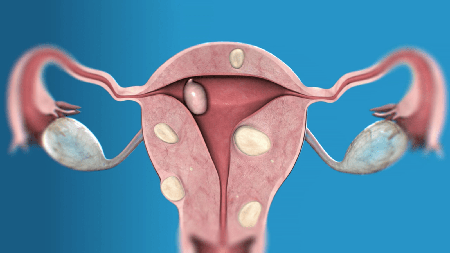 Эндоскопические операции при миоме матки